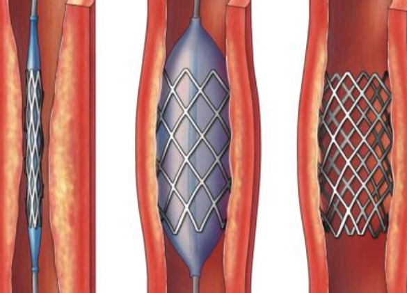 好消息！700元冠脈支架來了帶量采購結(jié)果在甘肅省正式落地執(zhí)行